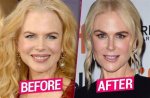 Discover Nicole Kidman's Facelift Journey: a Transformation Unveiled