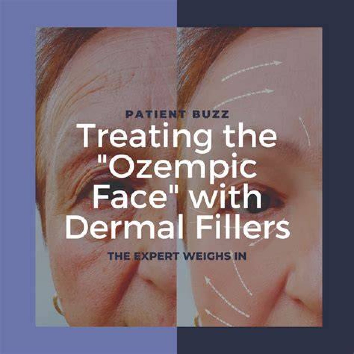 Lupus and Taking Ozempic: Understanding the Connection