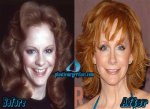 Reba Mcentires Plastic Surgery: the Truth Behind Her Ageless Beauty