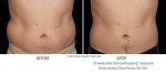 Results Gone Wrong: Cool Sculpting Before and After