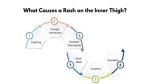 Understanding and Managing Inner Thigh Rash: a Comprehensive Guide