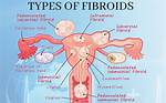 Understanding Uterine Fibroids in Relation to Brittney Griner: a Trans Perspective